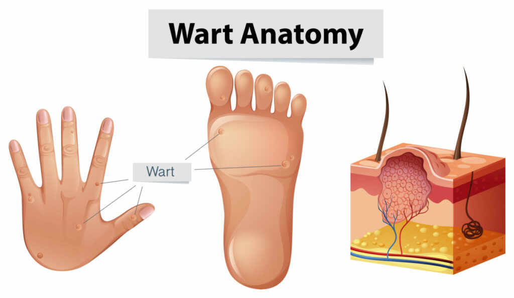 CBD Oil For Warts 